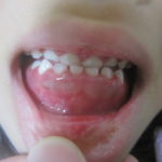 子供がヘルペス性歯肉口内炎になった体験談ー症状、対処法